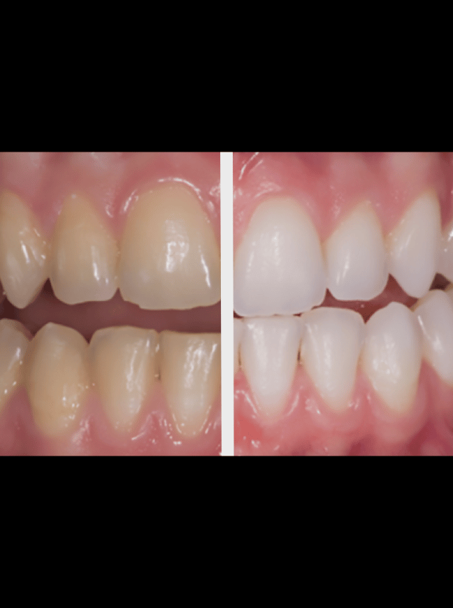 Teeth Whitening