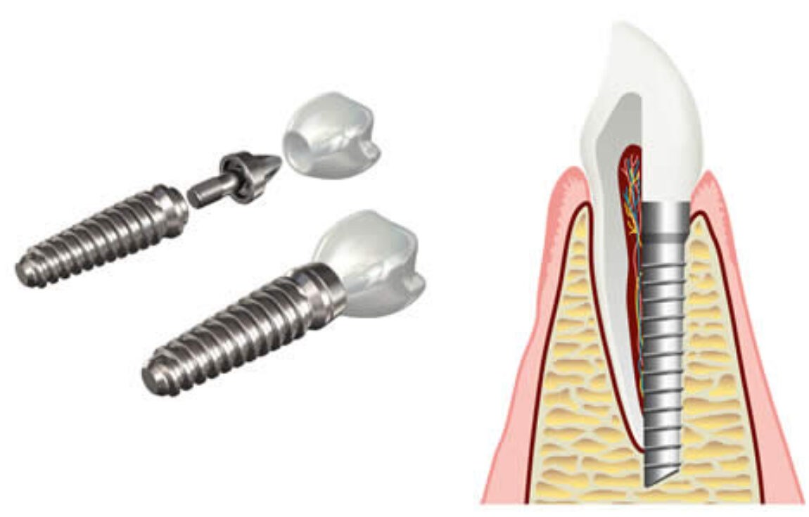 blog - Lighthouse Dental