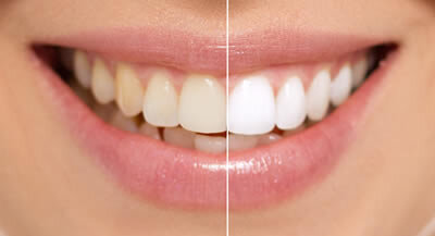 blog inner thumb : Lighthouse Dental