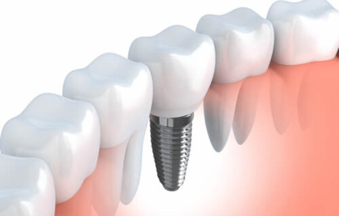 blog - Lighthouse Dental