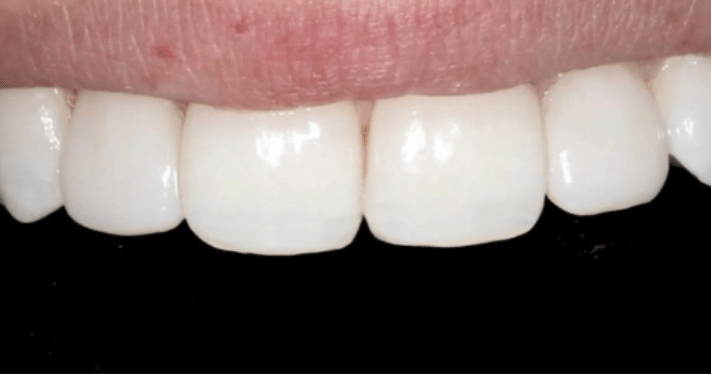 After - Lighthouse Dental