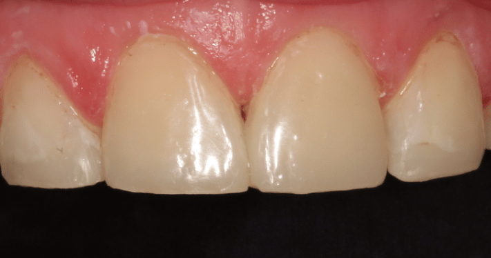 After - Lighthouse Dental