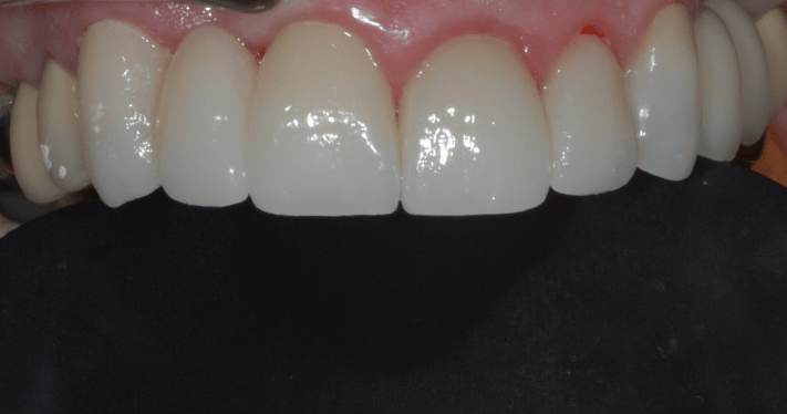 After - Lighthouse Dental