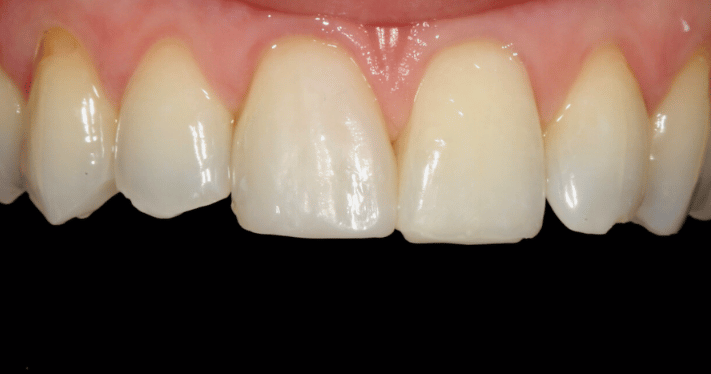 After - Lighthouse Dental