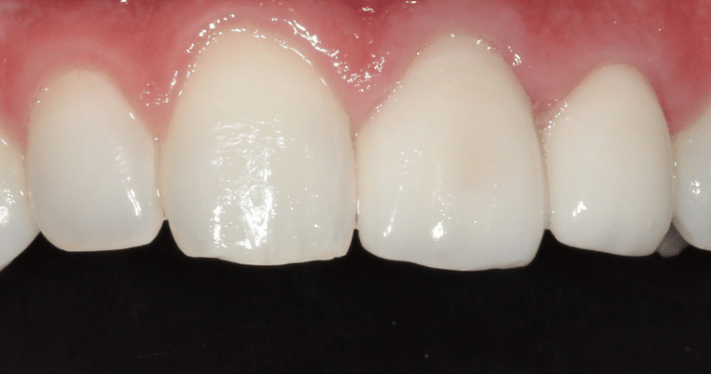 After - Lighthouse Dental