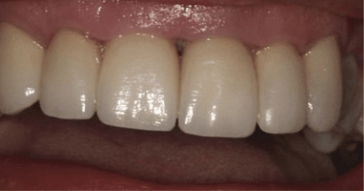 After - Lighthouse Dental