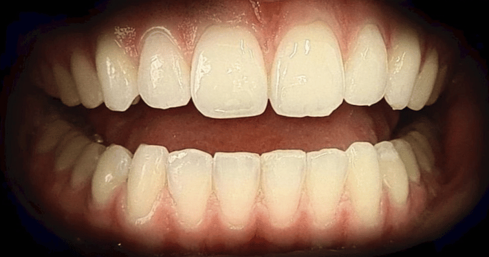 After - Lighthouse Dental