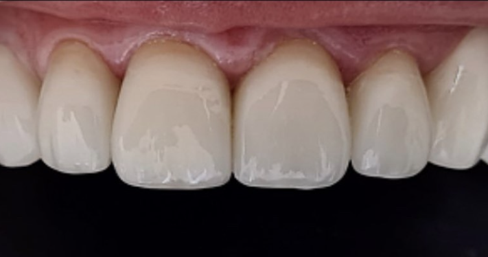 After - Lighthouse Dental